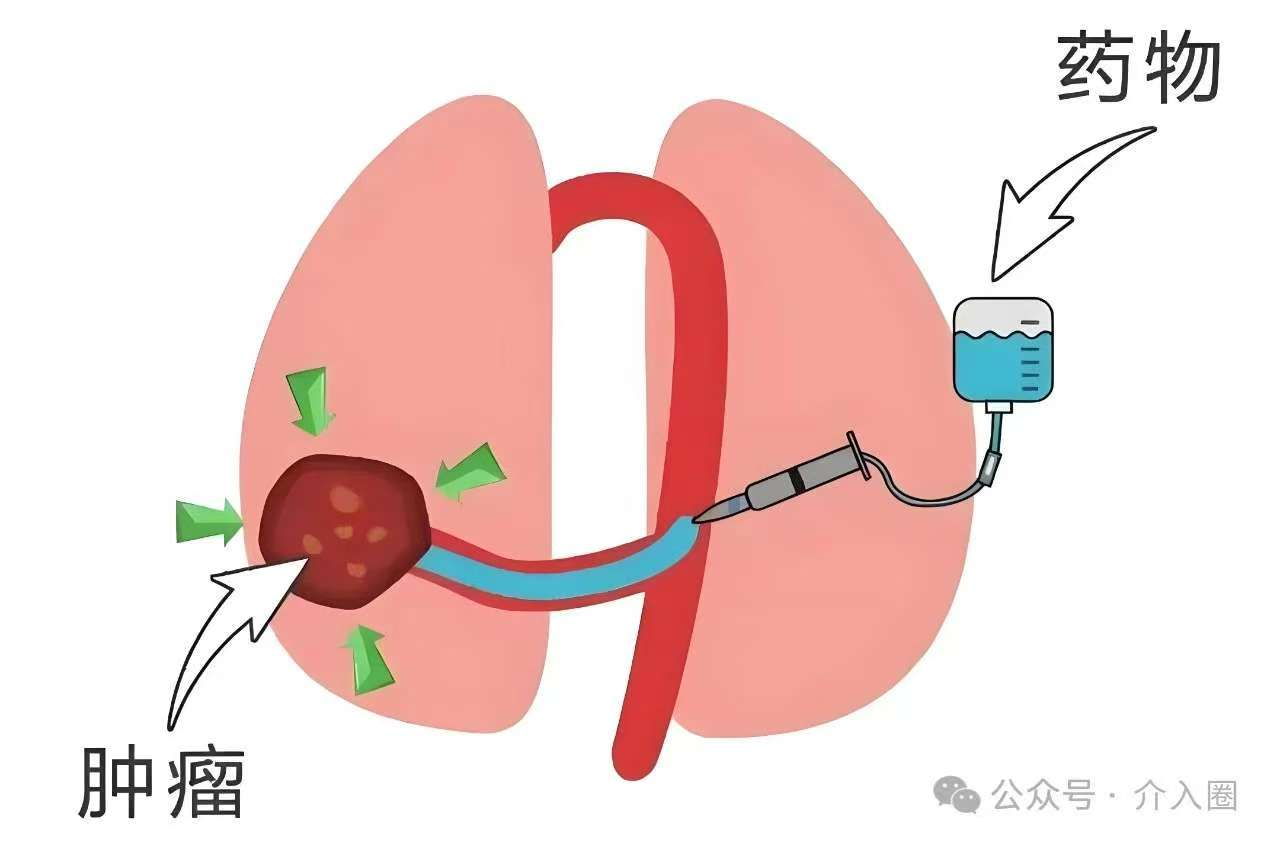 患者故事 | 一位腺癌患者跨越二十年的求医之路