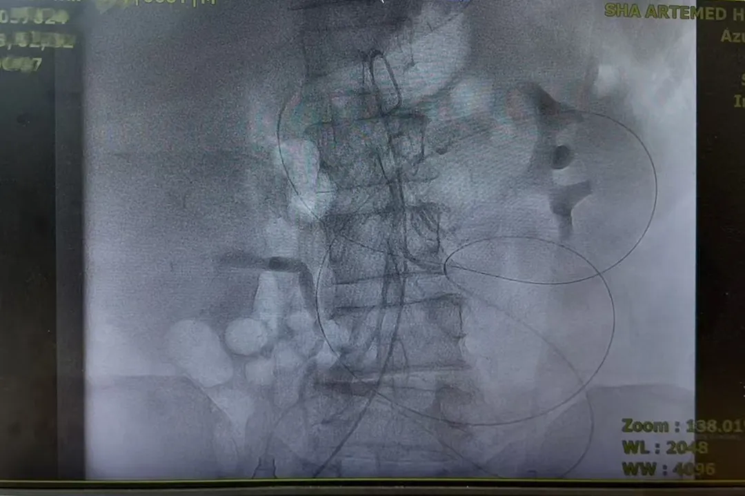 诊疗服务 | 介入治疗在晚期结肠癌中的优势