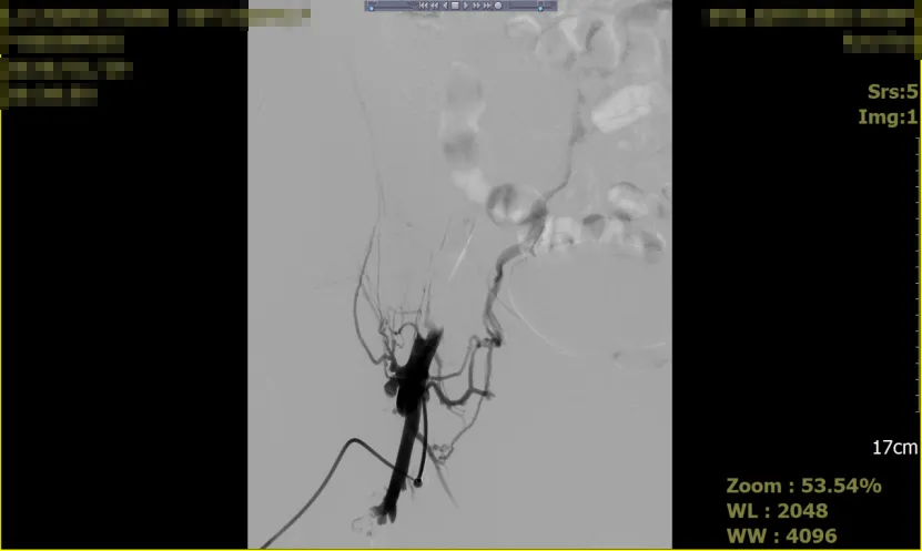 诊疗服务 | 下腔静脉滤器在血栓中的作用及应用